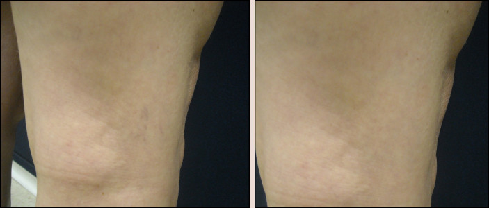 laser vein removal